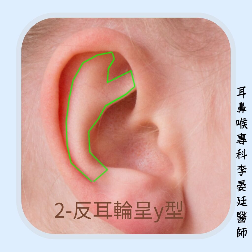 反耳輪應呈y型
