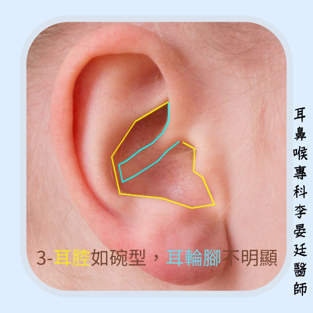 耳腔如碗型,耳輪腳應過於突出