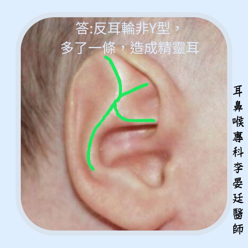 反耳輪多一條腳,形成精靈耳